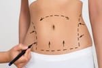 abdominoplastie-a-letranger